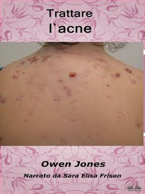 cover image of Trattare l'acne